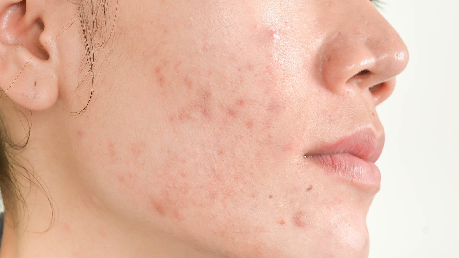 Acne Comedegénico