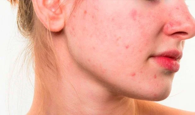 Acne Inflamatorio