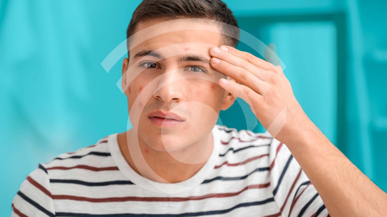 La Importancia de una Evaluación Dermatológica para el Acné