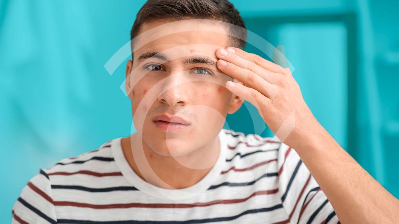 La Importancia de una Evaluación Dermatológica para el Acné