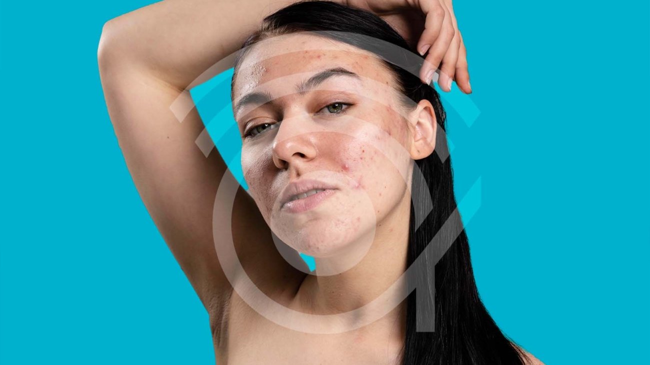 acné y cambios hormonales