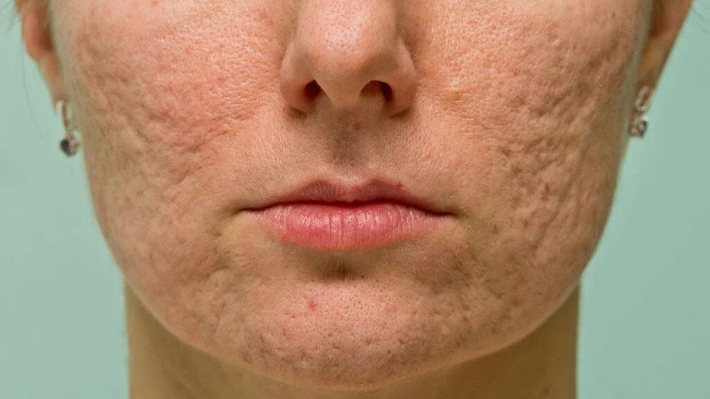 Causas hormonales y bacterianas