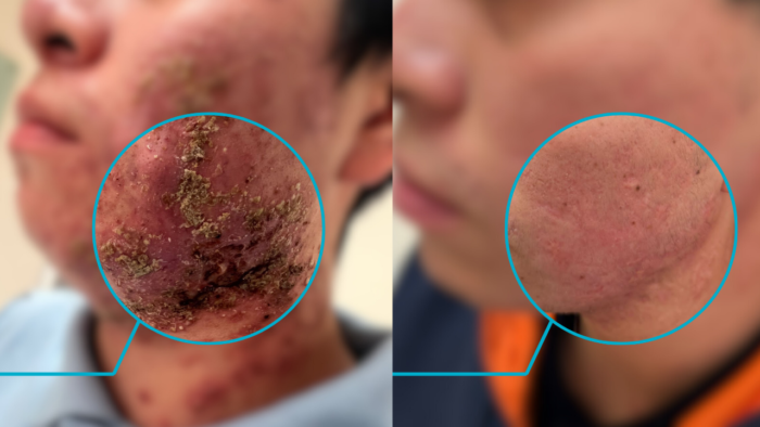 Resultados reales de pacientes Sinacné
