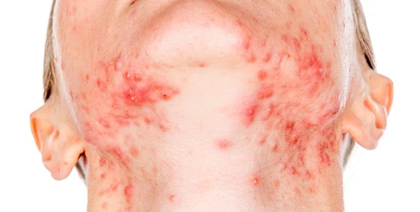 Nódulos, quistes y abscesos — Acné Severo