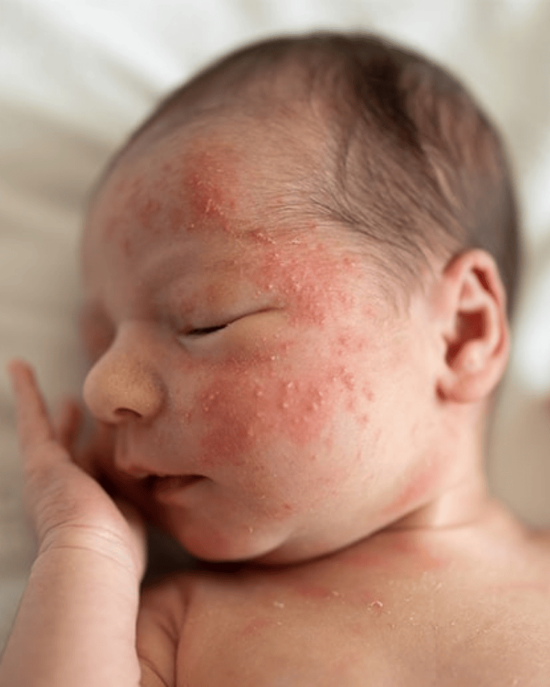 Acné Neonatal
